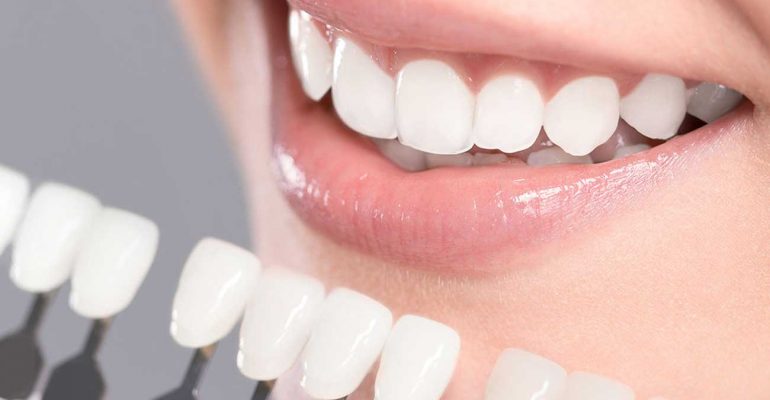 teeth-whitening-certification-classes